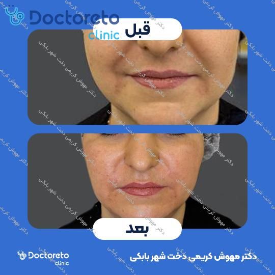 تزریق ژل خط خنده
