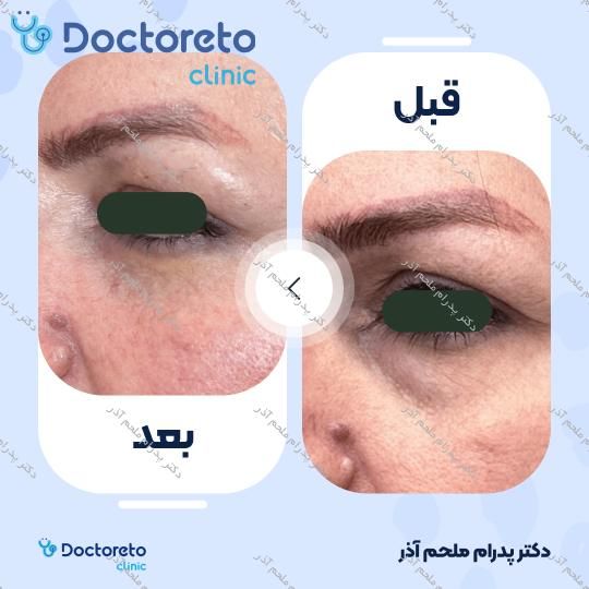 تزریق ژل زیرچشم