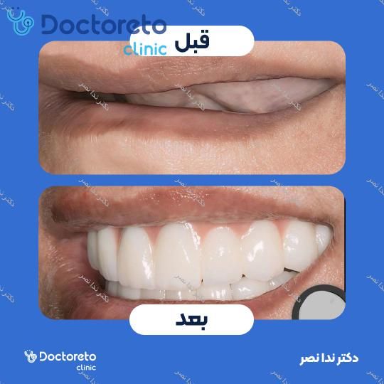 ایمپلنت دندان با روکش (هر واحد)