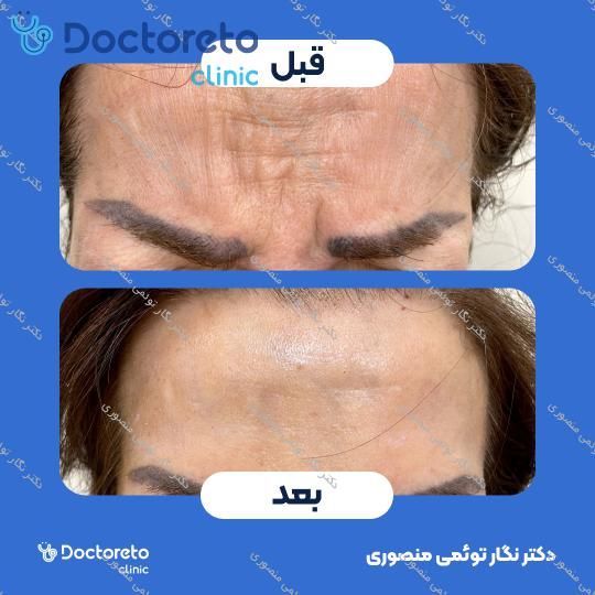 تزریق بوتاکس صورت (پیشانی، خط اخم، پنجه کلاغی)💉