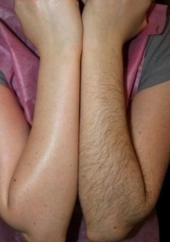 لیزر موهای زائد با دستگاه جونولوکس کره ای⚡