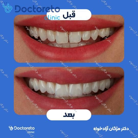 لمینت سرامیکی دندان (هر واحد)