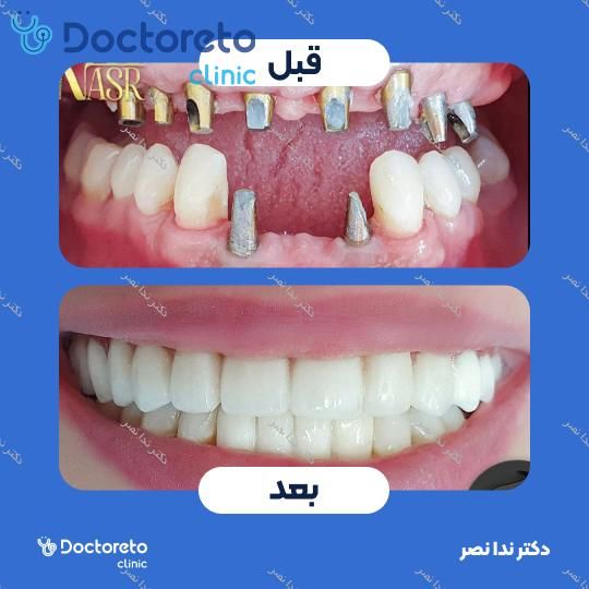 ایمپلنت دندان با روکش (هر واحد)