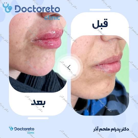 تزریق ژل چانه