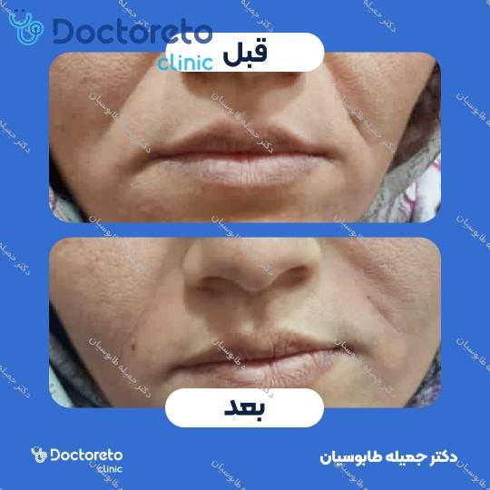 تزریق ژل خط خنده