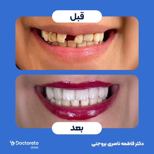 کامپوزیت دندان (هر واحد)