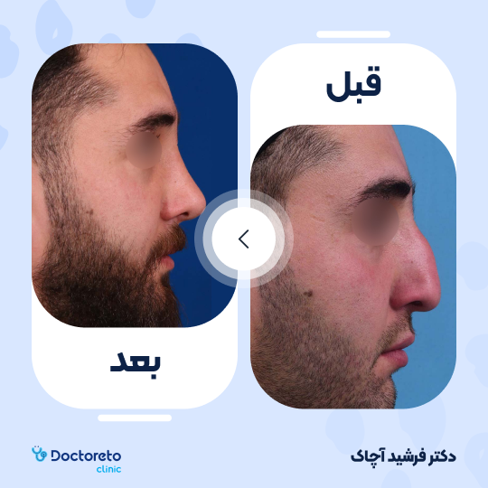 عمل زیبایی بینی استخوانی (رینوپلاستی)