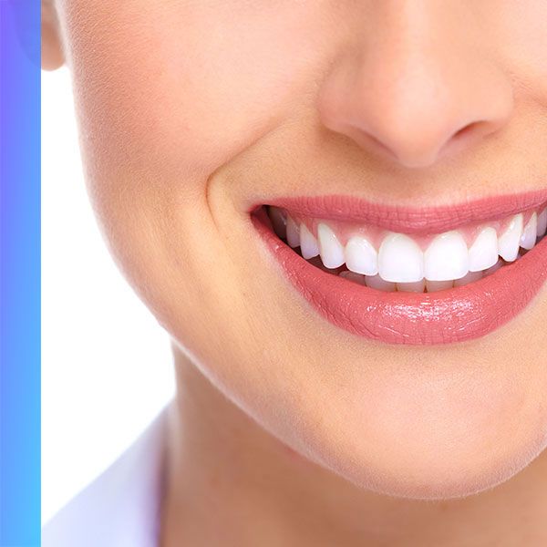 لمینت دندان (هر واحد)