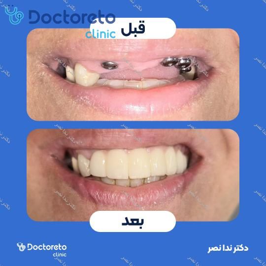 ایمپلنت دندان با روکش (هر واحد)