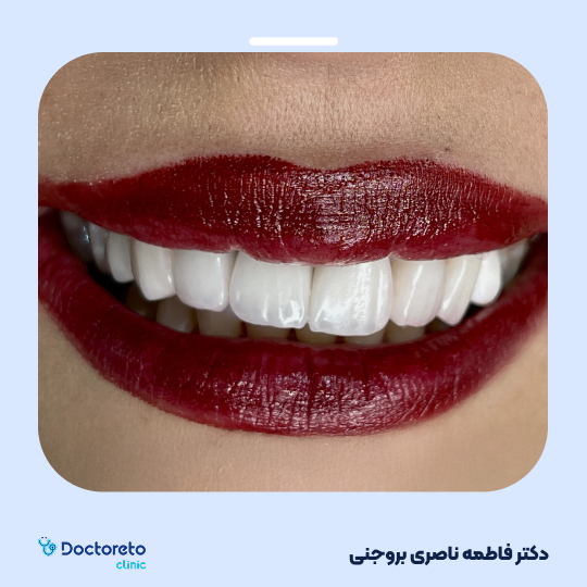 لمینت دندان (هر واحد)