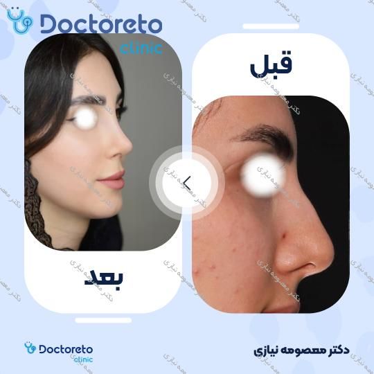 عمل جراحی مجدد زیبایی بینی (رینوپلاستی)