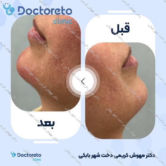 تزریق ژل چانه