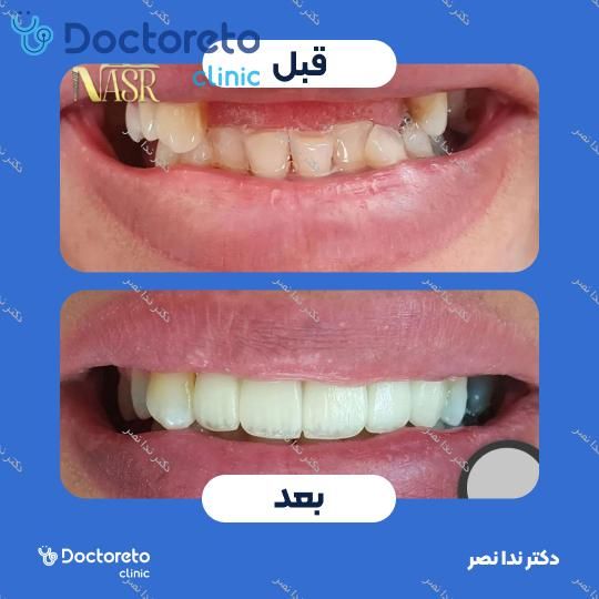 ایمپلنت دندان با روکش (هر واحد)