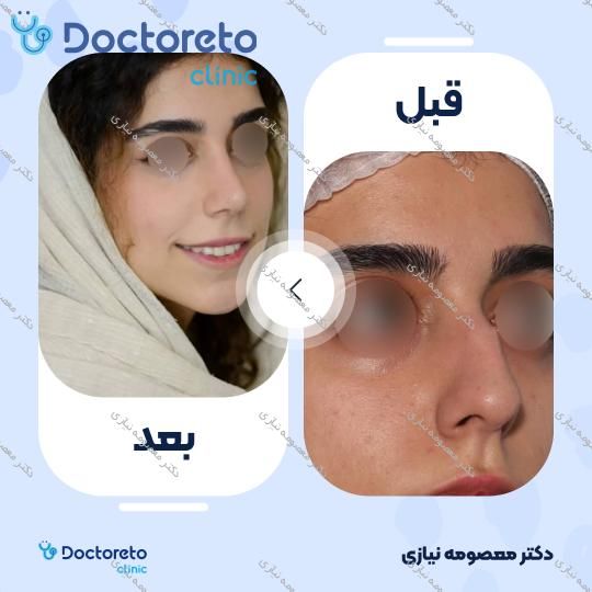 عمل جراحی زیبایی بینی نیمه فانتزی (رینوپلاستی)