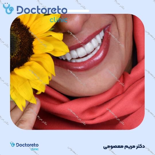 ونیر کامپوزیت (هر واحد)