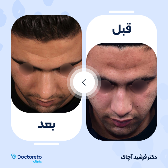 عمل زیبایی بینی گوشتی (رینوپلاستی)