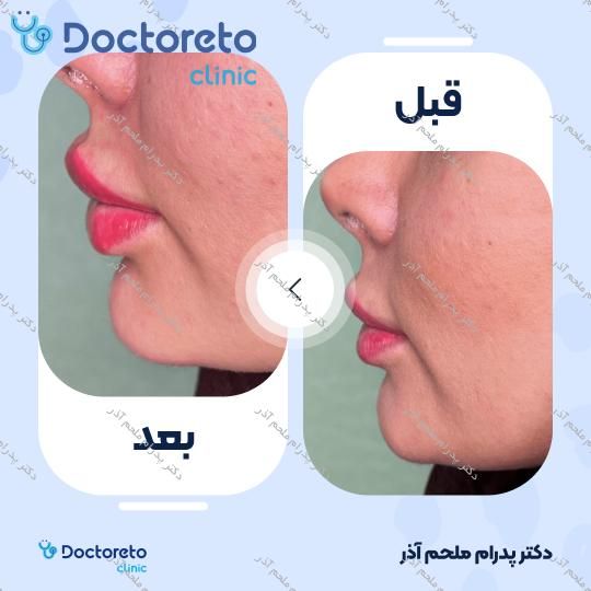 تزریق ژل چانه
