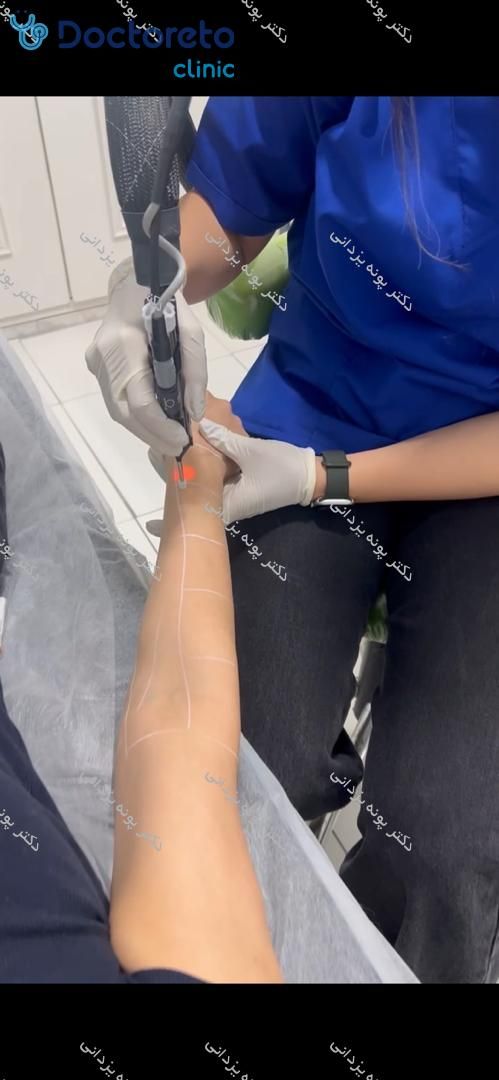 لیزر موهای زائد بادستگاه الیت پلاس⚡