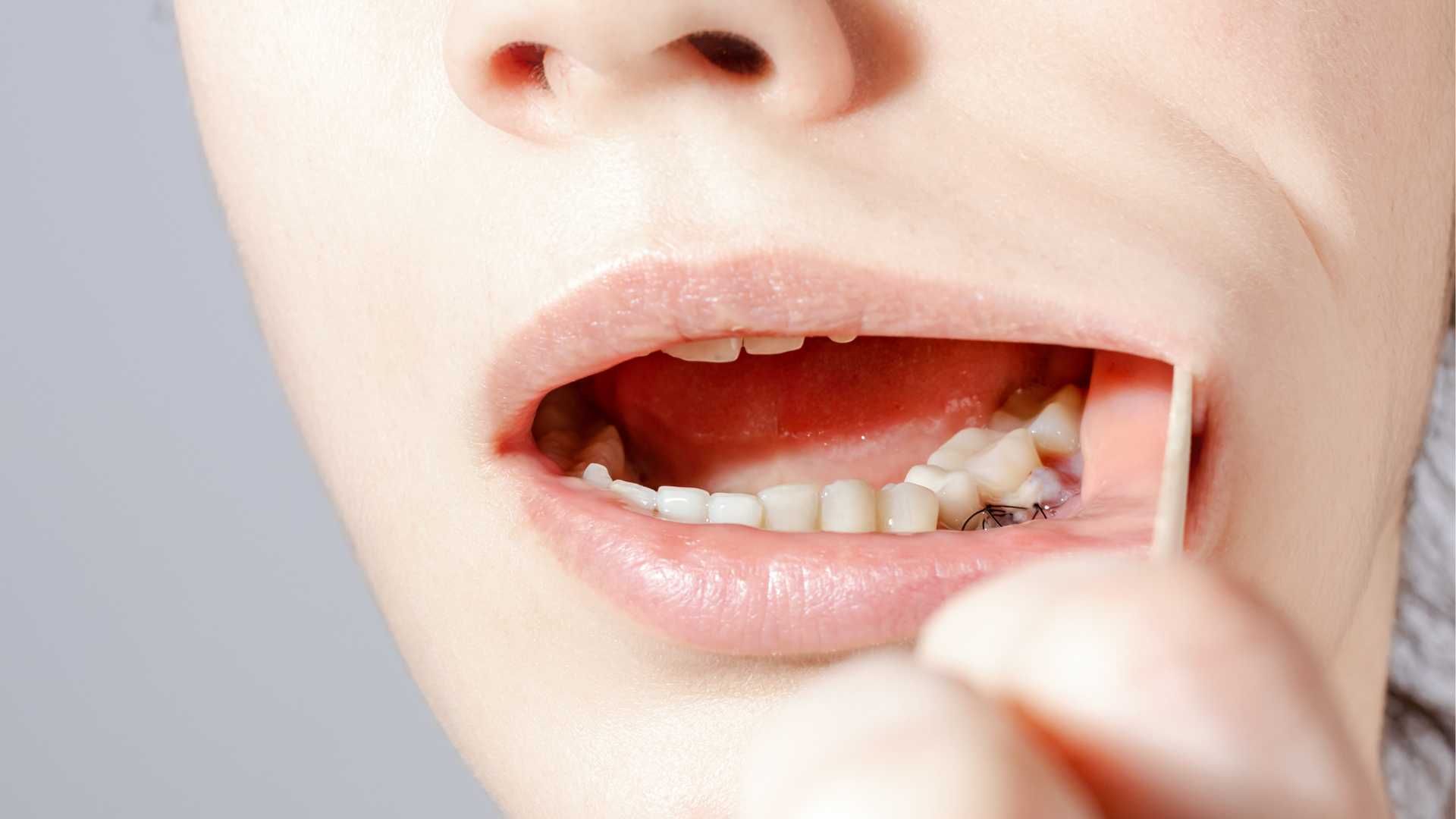 جراحی پیوند لثه