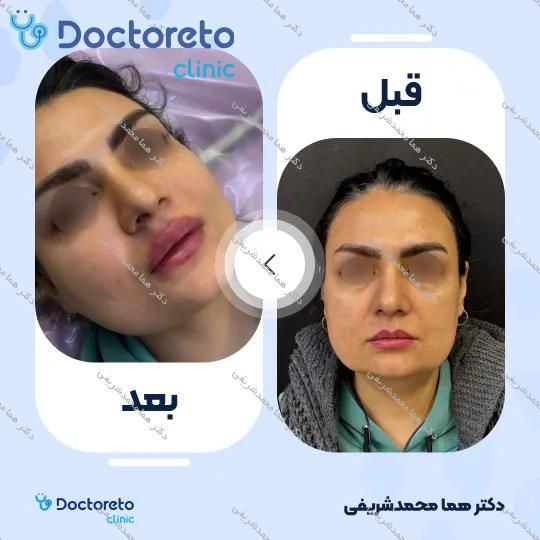 تزریق ژل لب