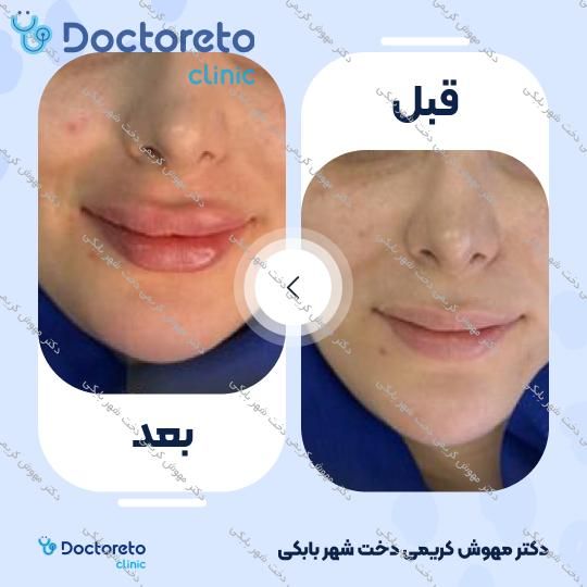 تزریق ژل لب