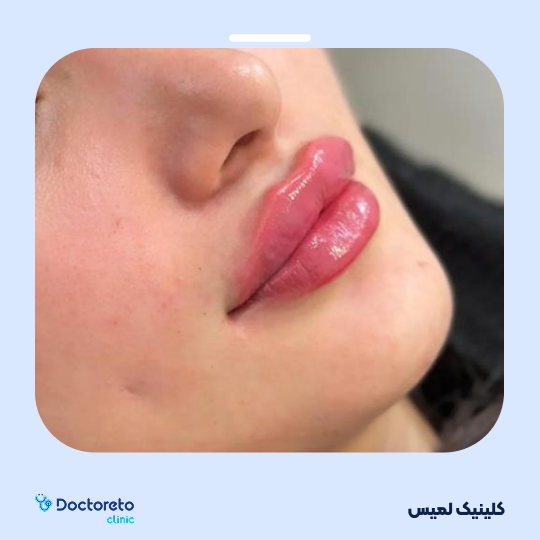 تزریق ژل لب