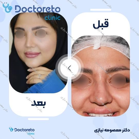 عمل جراحی زیبایی بینی گوشتی (رینوپلاستی)