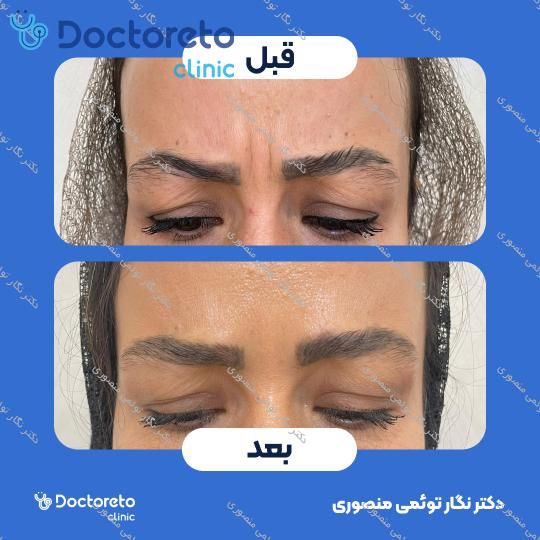تزریق بوتاکس صورت (پیشانی، خط اخم، پنجه کلاغی)💉