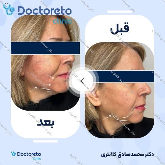 تزریق ژل زاویه فک