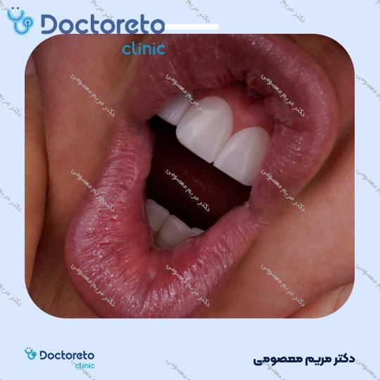 لمینت دندان (هر واحد)