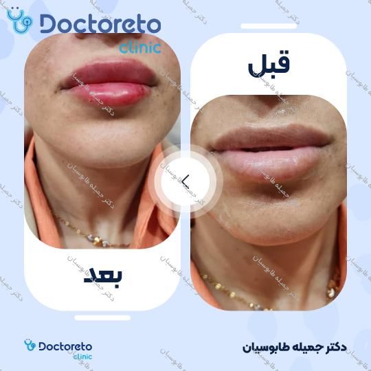 تزریق ژل لب