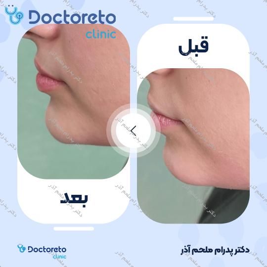 تزریق ژل چانه