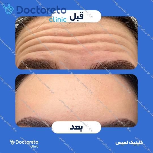 تزریق بوتاکس صورت (پیشانی، خط اخم، پنجه کلاغی)💉