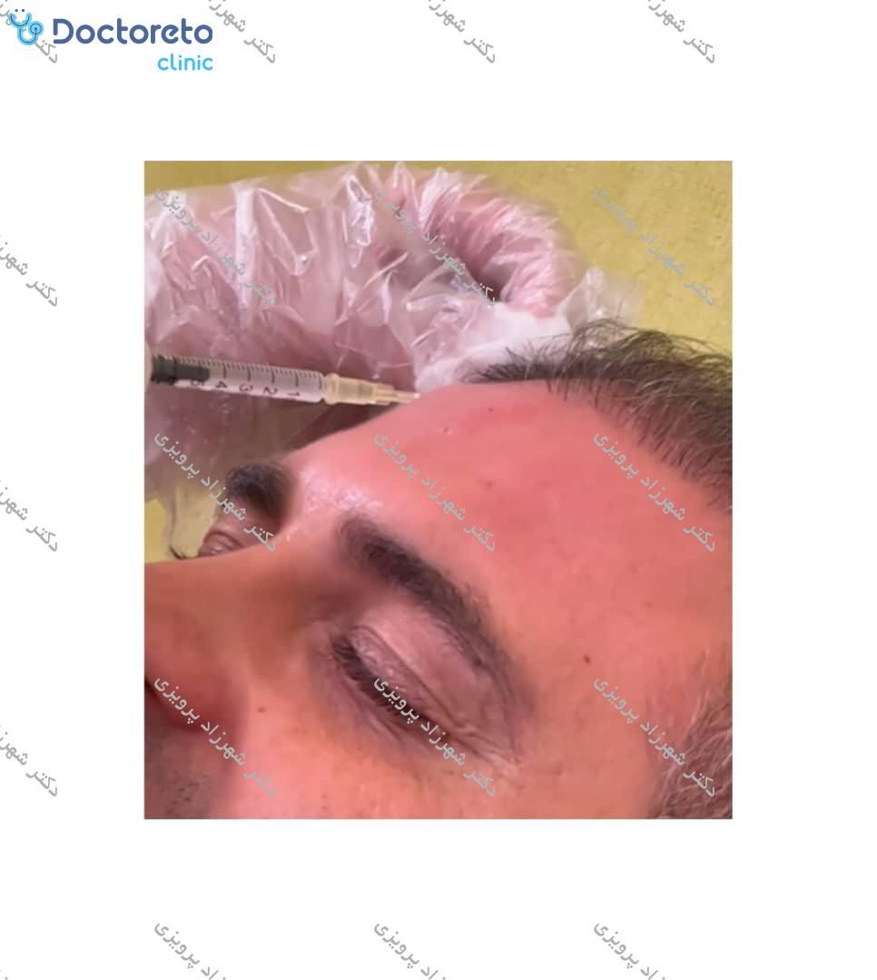 تزریق بوتاکس صورت (پیشانی، خط اخم، پنجه کلاغی)💉