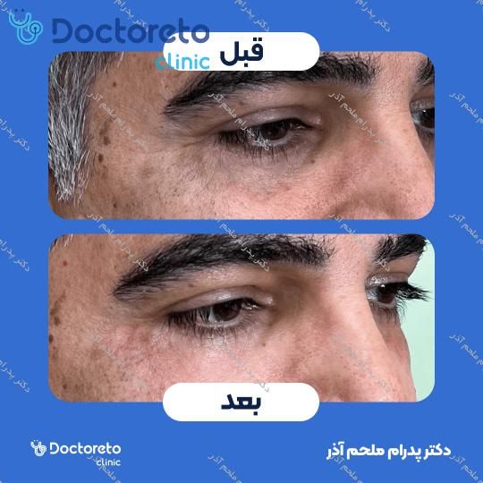 تزریق ژل زیرچشم