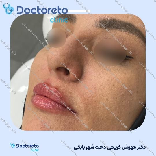 تزریق ژل لب