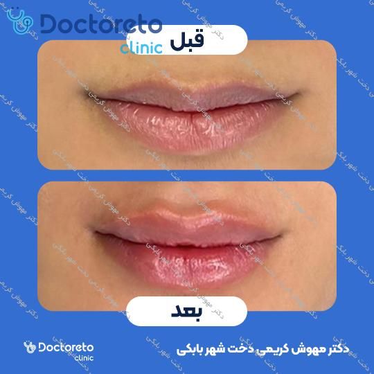 تزریق ژل لب