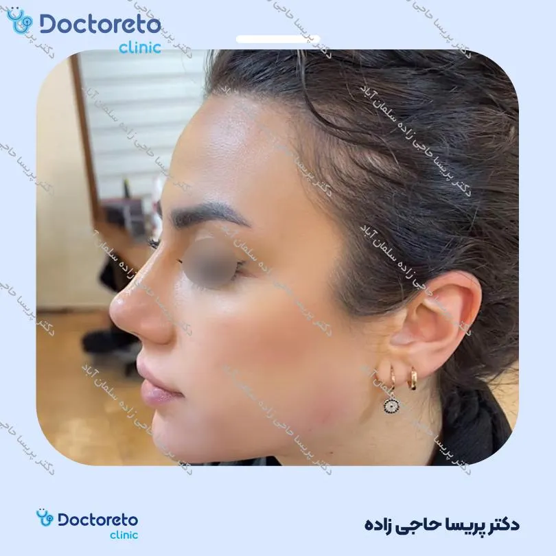 تزریق ژل زاویه فک