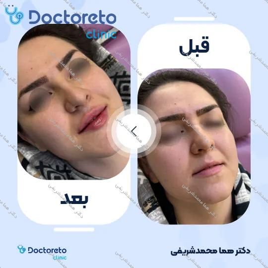 تزریق ژل لب