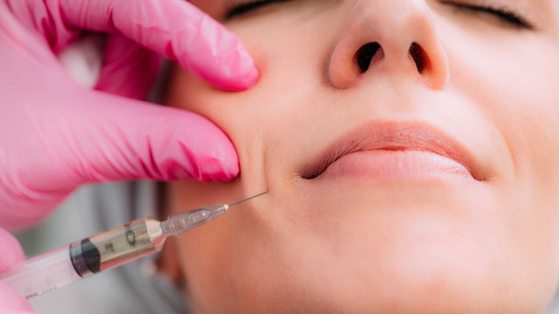 تزریق ژل خط خنده