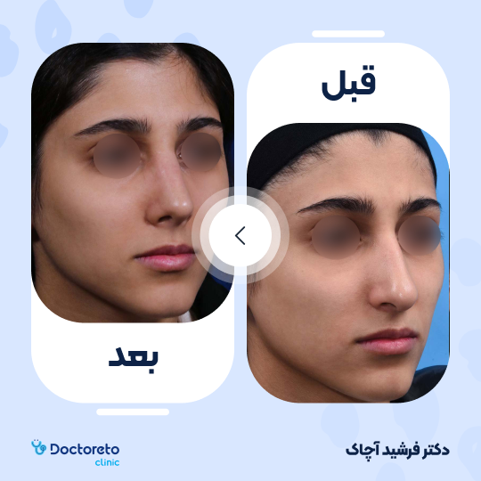 عمل زیبایی بینی استخوانی (رینوپلاستی)