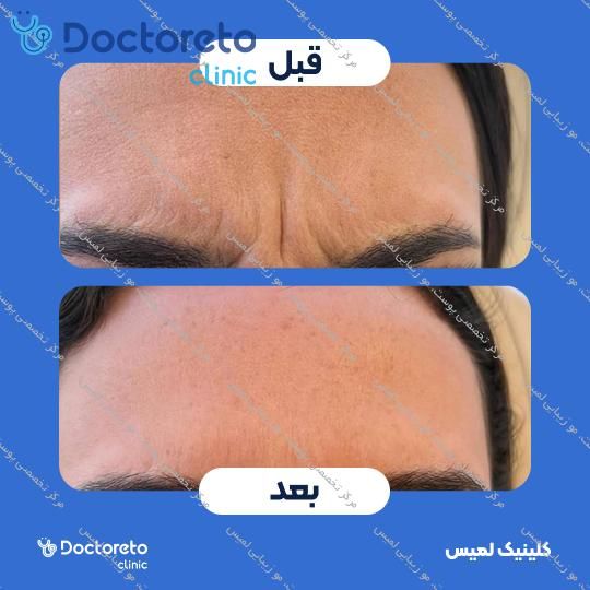 تزریق بوتاکس صورت (پیشانی، خط اخم، پنجه کلاغی)💉