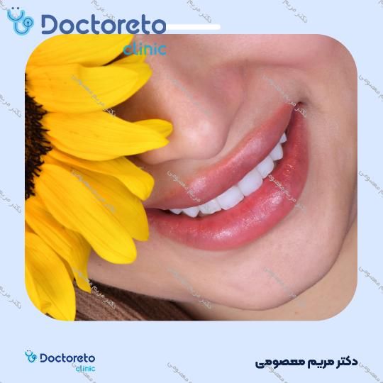 ونیر کامپوزیت (هر واحد)