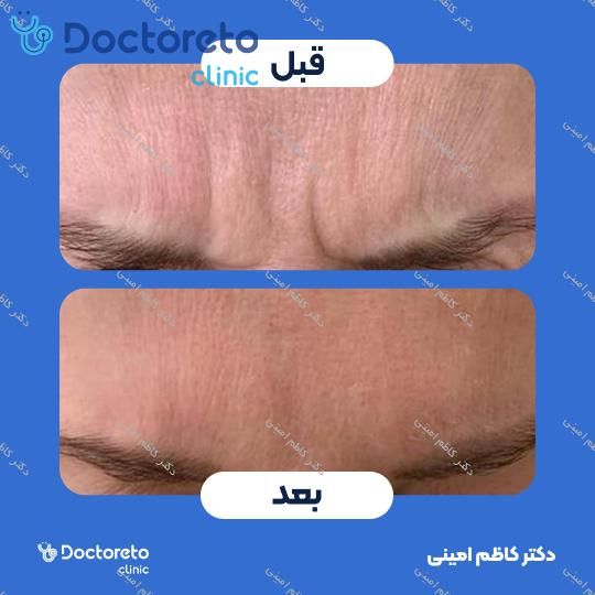تزریق بوتاکس صورت (پیشانی، خط اخم، پنجه کلاغی)💉