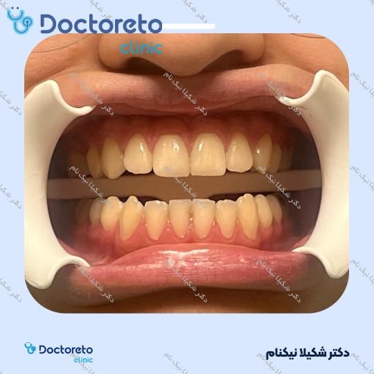 بلیچینگ دندان (سفید کردن دندان)