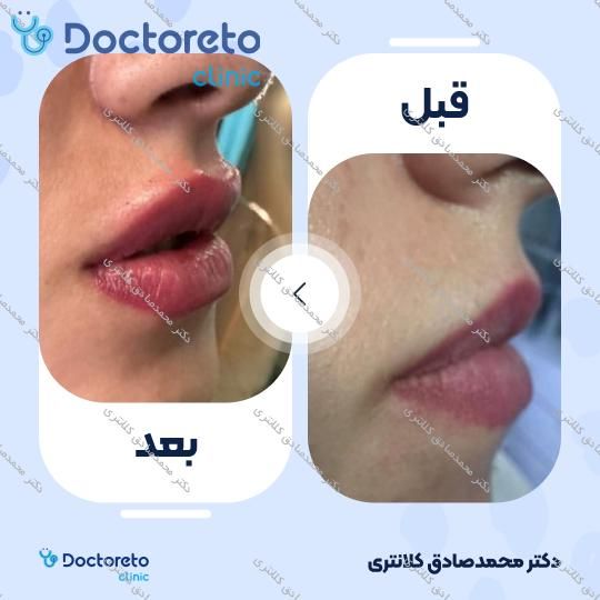 تزریق ژل لب