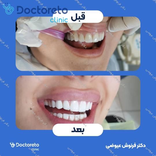 بلیچینگ دندان (سفید کردن دندان)