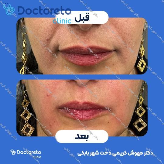 تزریق ژل خط خنده