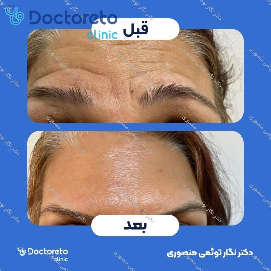 تزریق بوتاکس صورت (پیشانی، خط اخم، پنجه کلاغی)💉