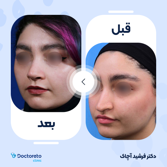 عمل زیبایی بینی استخوانی (رینوپلاستی)